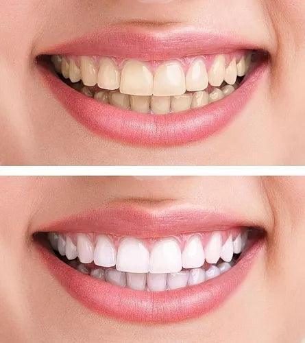 Blanqueador Dental Gel Tratamiento Dientes Blancos White - DSE